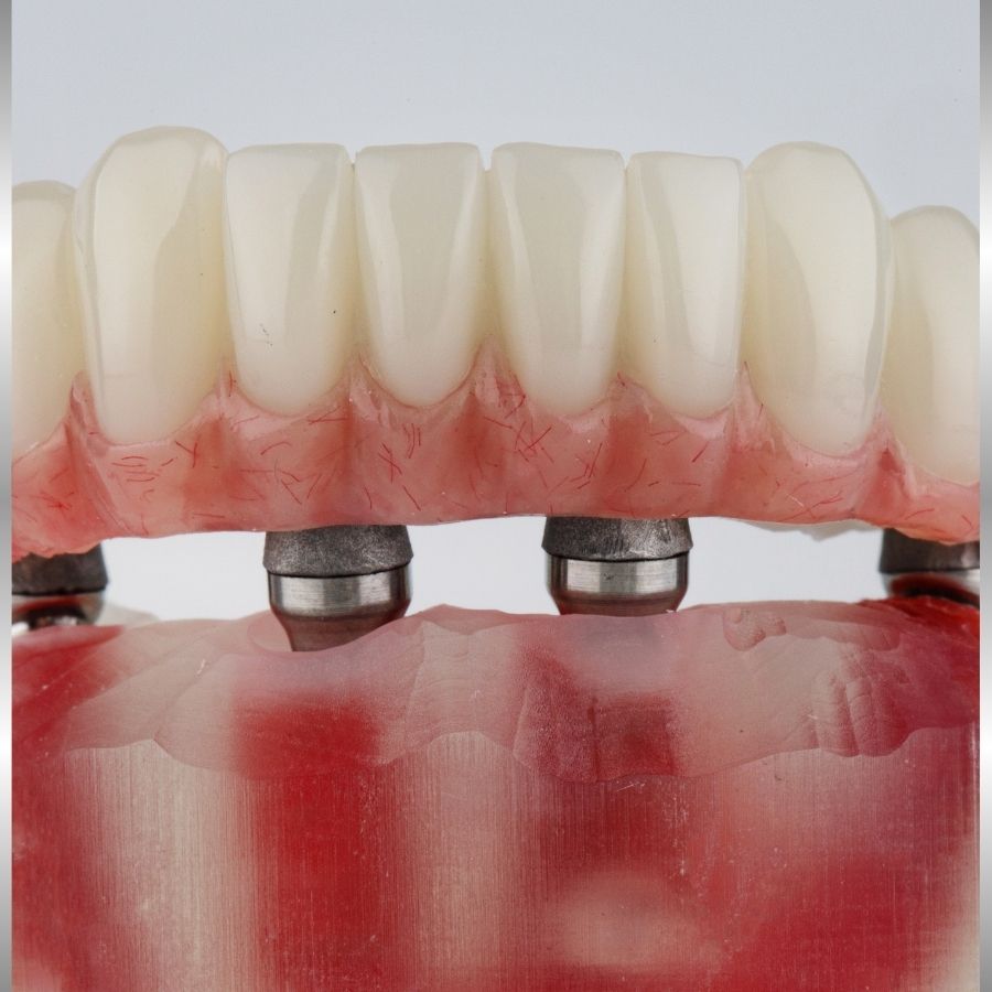 protese protocolo.jpg